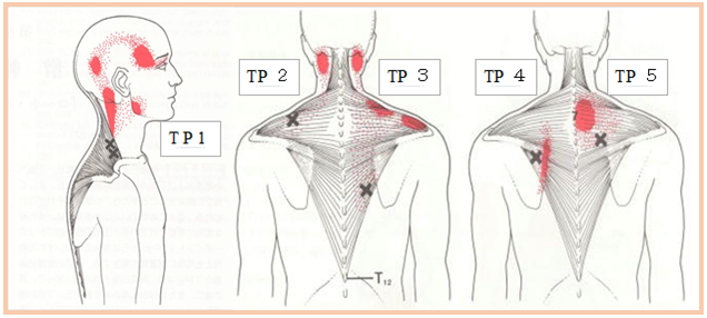 僧帽筋のトリガーポイント疼痛パターンの図